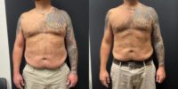 45-54 year old man treated with Ozempic for Weight Loss