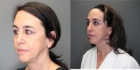 45-54 year old woman treated with Brow Lift, Eyelid Surgery, Facelift