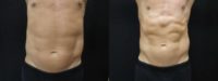 51 year old man 12 weeks after 1 SculpSure treatment