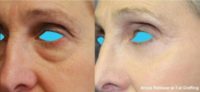 45-54 year old woman treated with Eyelid Surgery - Arcus Marginalis release with fat grafting