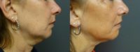 54 year old neck and face treatment with Ultherapy