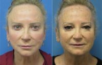 55-64 year old woman treated with Facelift/Blepharoplasty