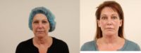 56 year old woman underwent facelift with fat transfer and earlobe reduction.