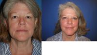 57 year old woman treated with Facelift