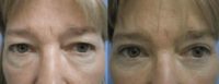 57 year old woman treated with Eyelid Surgery