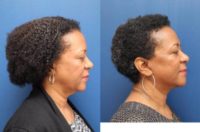 58 year old female who had a SMAS plication facelift and she is shown 1 year afterward