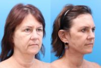 55-64 year old woman treated with Facelift, Neck Lift, Eyelid Surgery, Laser Resurfacing
