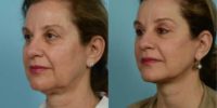 55-64 year old woman treated with Lower Facelift