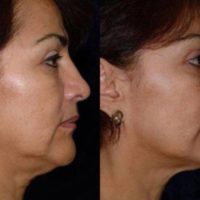 55-64 year old woman treated with ThermiSmooth Face