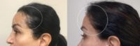 55-64 year old woman treated with Hair Transplant, FUE Hair Transplant