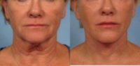 62 year old female facelift