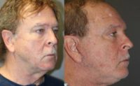 62 year old man treated with Neck Lift