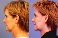 62 year old woman treated with Facelift and Necklift.