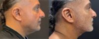 55-64 year old man treated with Nonsurgical Neck Lift
