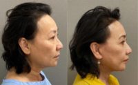65-74 year old woman treated with Facelift/ Neck Lift
