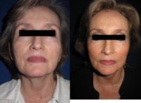 65-74 year old woman treated with Lower Face Lift and Central & Malar Fat Grafting