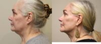 65-74 year old woman treated with Lower Facelift