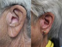 65-74 year old woman treated with Ear Lobe Surgery