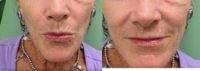65-74 year old woman treated with Lip Fillers