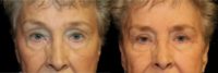 68 year old woman treated with Eyelid Surgery
