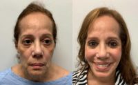 65-74 year old woman treated with Mini Facelift