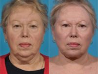72 year-old woman with SMAS Facelift, Submental Plication (Neck Lift), Upper & Lower Blepharoplasty