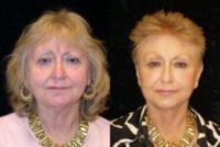 75 and up year old woman treated with Neck Lift