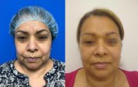 45-54 year old woman treated with Facelift, Chin Liposuction