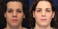 25-34 year old transgender woman treated with Rhinoplasty and Facial Feminization