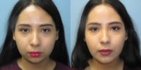 18-24 year old woman treated with Chin Implant