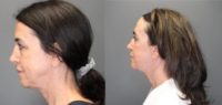 45-54 year old woman treated with Brow Lift, Eyelid Surgery, Facelift