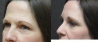 45-54 year old woman treated with Forehead Lift