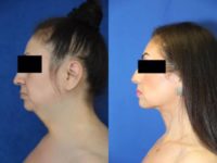 35-44 year old woman treated with Liposuction
