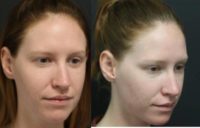 25-34 year old woman treated with Cheek Augmentation