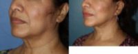 58 Year Old Face Lift Patient