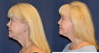68 year old woman treated with Facelift & Quad Blepharoplasty