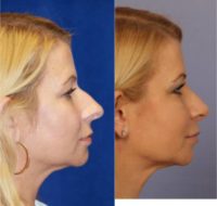 47 year old woman treated with Rhinoplasty