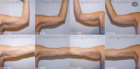 35-44 year old woman treated with Arm Lift, Body Lift