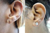 35-44 year old woman treated with Earlobe Surgery