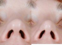 29 year old woman treated with Rhinoplasty