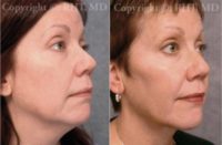 48 year old woman treated with Cheek Implants and Submental fat removal