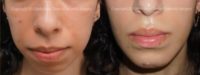 Woman treated with Chin Implant, Chin Filler