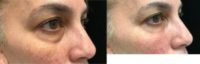 50 year old woman treated with Dermal Fillers
