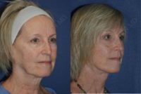 55-64 year old woman treated with Facelift, temporal browlift, and lower eyelid blepharoplasty