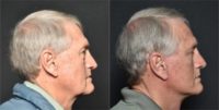 65-74 year old man treated with Facelift, Neck Lift, Eyelid Surgery