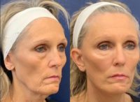 55-64 year old woman treated with Facelift, Brow Lift
