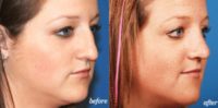 18-24 year old woman treated with Septoplasty