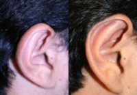 Man treated with Ear Surgery