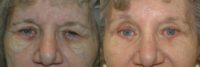 Browlift upper and lower blepharoplasty