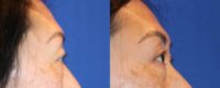 45 year-old female under upper eyelid surgery (blepharoplasty).